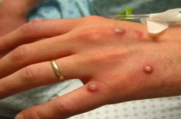 원숭이두창(Monkeypox)바이러스는 주로 서아프리카와 중앙아프리카의 국가에서 발생하며, 증상은 매우 가렵거나 고통스럽다.