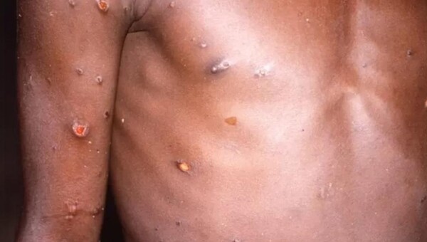 미국, 캐나다, 호주뿐만 아니라 국내에서도 첫 감염자가 확인됐다.(사진=로이터)