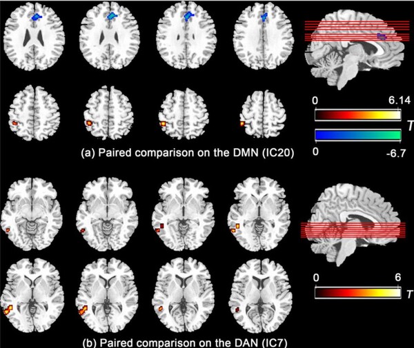 DMN 및 DAN에 대한 추가 쌍 비교(그림 2) HT 조건 동안 DMN의 IC20에서 mPFC / ACC에서 FC 감소 및 왼쪽 하두정엽에서 FC 증가를 나타 냈지만 측두엽 접합 영역 근처의 중간 및 하 측두 이랑의 후부에서 FC DAN의 IC7에서 HT 조건 동안 크게 증가했다.(사진= National Institutes of Health) 